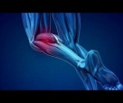 3D презентация медицинского метода Ульзибата